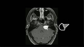 Rethinking Vestibular Schwannoma [upl. by Akemit]