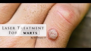 Warts removal with Laser Treatment  Dr Chiam CT [upl. by Adnuahsal]