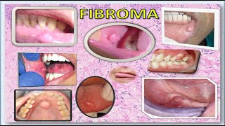 Fibroma [upl. by Lauer]