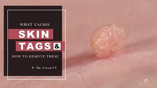 Skin Tags Seborrheic Keratosis amp Warts  Whats the difference  Dr Chiam CT [upl. by Sharline]