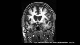 Huntingtons Disease [upl. by Meedan]