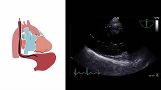 Mastering important TEE views transesophageal echocardiography [upl. by Anelec434]