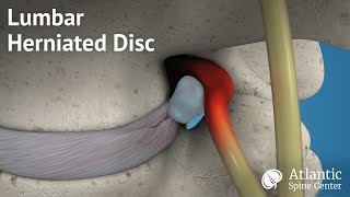 Lumbar Herniated Disc Overview [upl. by Wixted]