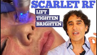 SCARLET RF  Non Surgical Face Treatment [upl. by Larkin]