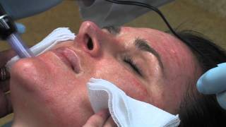 Dr Mark B Taylor Review of Dermapen Micro Needling  Gateway Aesthetics [upl. by Ardnoed]