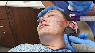 Full Face Fractional CO2 Laser Resurfacing for Wrinkles and Skin Tightening [upl. by Yeltrab185]