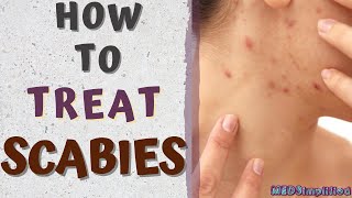 HOW TO TREAT SCABIESscabies treatment at home [upl. by Enael]