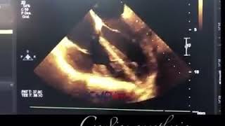 Ventricular fibrillation under ULTRASOUND [upl. by Daffie903]