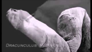 Dracunculus medinensis Parasitology Video [upl. by Ailedroc]