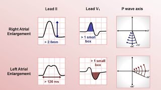 Intro to EKG Interpretation  Chamber Enlargement [upl. by Amled]