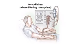 Dialysis Access and Fistula Procedure [upl. by Dnomayd]