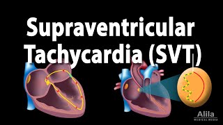 Supraventricular Tachycardia SVT PSVT Animation [upl. by Dor620]