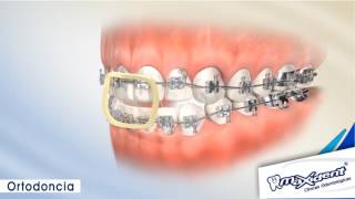 Corrección de mordida y espacios dentales quotOrtodonciaquot [upl. by Borroff]