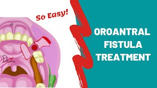 Oroantral Fistula  Treatment Options  ORAL SURGERY [upl. by Nnylirej]