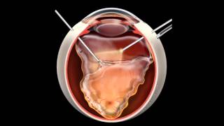 Retinal Detachment  Signs Symptoms and Treatment [upl. by Cheston]