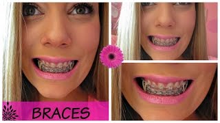 Adult Braces Elastics Powerchain Brackets [upl. by Ahteres]