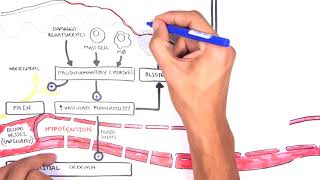 Burns DETAILED Overview  Types Pathophysiology TBSA [upl. by Fonda]