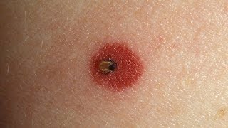 How to Spot Lyme Disease  WebMD [upl. by Bashee788]