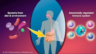 What is Crohns Disease [upl. by Heywood]