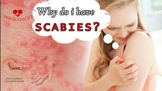 Scabies mites coming out of my skin [upl. by Erehc]