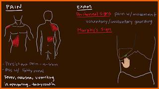 Acute Cholecystitis 23 [upl. by Rramo991]