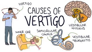 Vertigo Treatment  Epley Maneuver  American Academy of Neurology [upl. by Ellebanna]