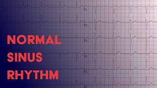 Normal Sinus Rhythm  EKG ECG Interpretation [upl. by Imugem]