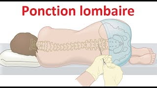 Ponction lombaire Examen du liquide céphalorachidien LCR [upl. by Mahala]