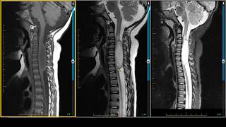 A Patient With Severe Cervical Dystonia [upl. by Onirefez]