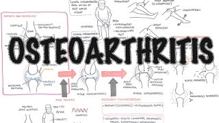 What is Osteoarthritis [upl. by Yrallam43]