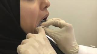 Dentiscope  How to Take Bitewing Radiograph [upl. by Sherborne100]