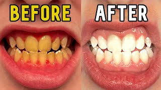 How I Whitened My Teeth in 14 Days [upl. by Willem]