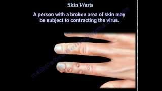 Skin Warts  Hand warts  Everything You Need To Know  Dr Nabil Ebraheim [upl. by Arihaz]