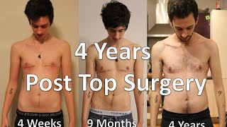 FTM Transgender 4 Years Post Top Surgery [upl. by Freida]