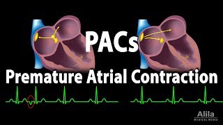 Premature Atrial Contractions PACs Animation [upl. by Palgrave]