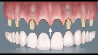 Prótesis fija sobre Implantes  Madrid [upl. by Dorey]