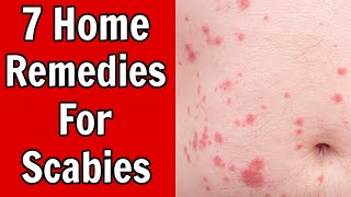 7 Home Remedies For Scabies [upl. by Abebi]