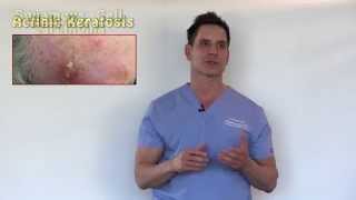 PreCancers or Actinic Keratosis Treatment Options With Dr Timothy Jochen [upl. by Ecinnaj]