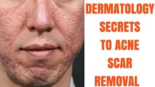 Acne scar treatments ULTIMATE GUIDE [upl. by Alix61]