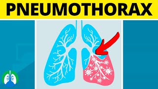 Pneumothorax Medical Definition  Quick Explainer Video [upl. by Clarisa661]