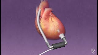 Mayo Clinic Minute How ventricular assist devices can help heart patients [upl. by Farica100]