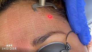 Minimize Acne Scarring With Laser Resurfacing [upl. by Sevik]