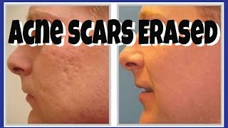 HOW TO COVER ACNE SCARS FLAWLESSLY  Tutorial  CHRIS GIBSON [upl. by Ellerihs]