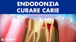 Endodonzia – Curare carie profonda © [upl. by Hermann]