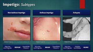 Impetigo Subtypes [upl. by Aneladdam]