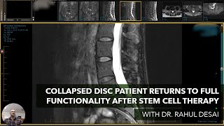 Degenerative Disc Disease with Osteophyte Formation  Biospine [upl. by Grose]