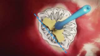 Transcatheter Mitral Valve Replacement Neovasc [upl. by Aracot]