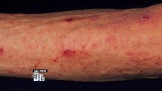 Scabies from the Gym [upl. by Orvah]