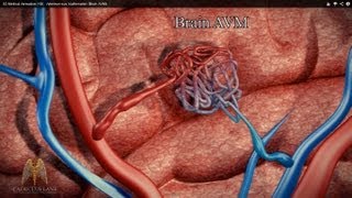 3D Medical Animation HD  Arteriovenous Malformation Brain AVM [upl. by Vassar]