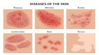 SAKIT sa BALAT Pimples Rushes Eczema Pigsa  ni Doc Katty Go Dermatologist 21b [upl. by Ennirroc769]